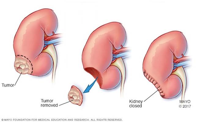 https://www.mayoclinic.org/-/media/kcms/gbs/patient-consumer/images/2013/08/26/10/36/my01181_im04375_mcdc7_partial_nephrectomythu_jpg.jpg