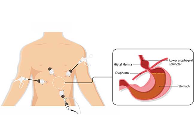 https://totaluppergisurgery.com.au/wp-content/uploads/2019/05/operation-hiatal-hernia.jpg