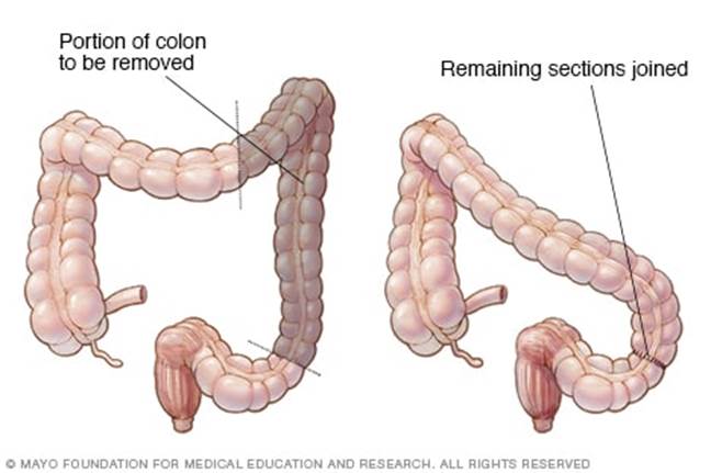 https://www.mayoclinic.org/-/media/kcms/gbs/patient-consumer/images/2013/08/26/10/38/my00141_im00232_c7_left_hemicolectomythu_jpg.jpg