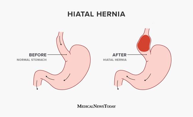 https://post.medicalnewstoday.com/wp-content/uploads/sites/3/2022/05/1750256_What-to-know-about-hiatal-hernia-surgery-01-1024x623.jpg