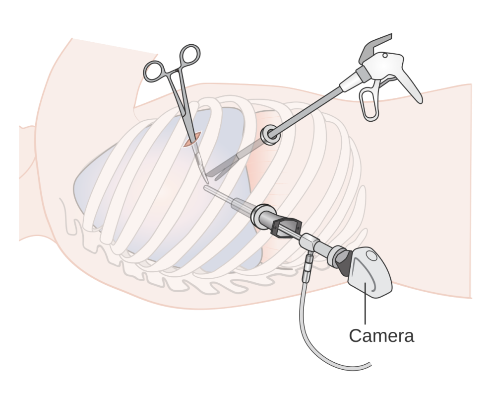 https://upload.wikimedia.org/wikipedia/commons/thumb/c/c8/Diagram_showing_video_assisted_thoracoscopy_%28VATS%29_CRUK_378.svg/1200px-Diagram_showing_video_assisted_thoracoscopy_%28VATS%29_CRUK_378.svg.png