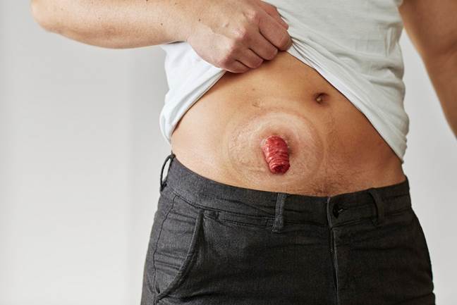 https://www.coloplastcharter.co.uk/globalassets/charter/advice-and-support/ostomy-support/ostomy-surgery/what-will-my-stoma-be-like/lowres-cpoc_sensuramio_nicolaj-brusendal_lifestyle_04589_01_2.jpg