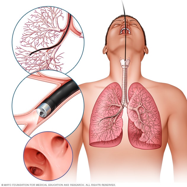 https://www.mayoclinic.org/-/media/kcms/gbs/patient-consumer/images/2016/09/01/14/38/mcdc7_bronchoscopy-8col.jpg
