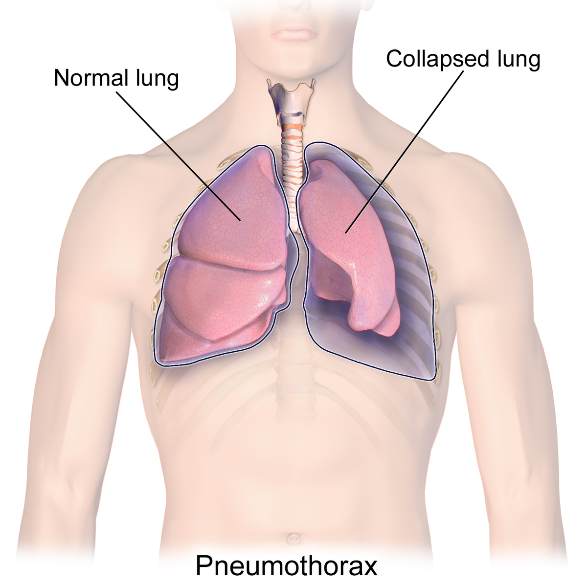 https://upload.wikimedia.org/wikipedia/commons/thumb/4/46/Blausen_0742_Pneumothorax.png/1200px-Blausen_0742_Pneumothorax.png