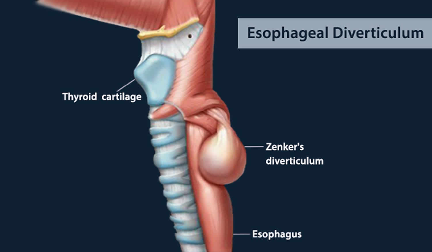 esophageal diverticulum