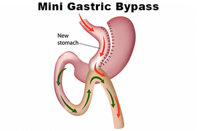 https://queenslandbariatrics.com.au/wp-content/uploads/elementor/thumbs/mini-gastric-img-1-oyhu3y1wujmyl5nu66uvnpuckkp4crjfl3h31rk1wg.png