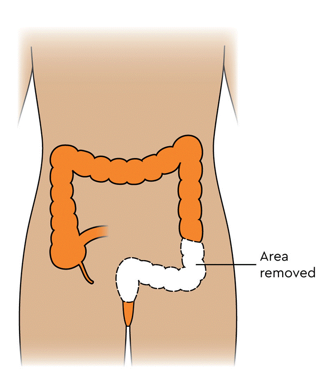 MACD121_Rectal-surgery---anterior-resection-area-removed,-pale-skin_labelled.png