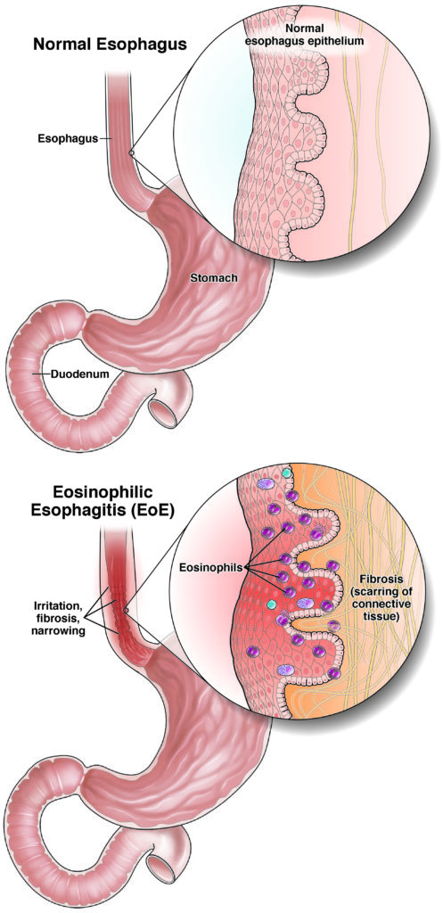 Eosinophilic esophagitis (EoE)