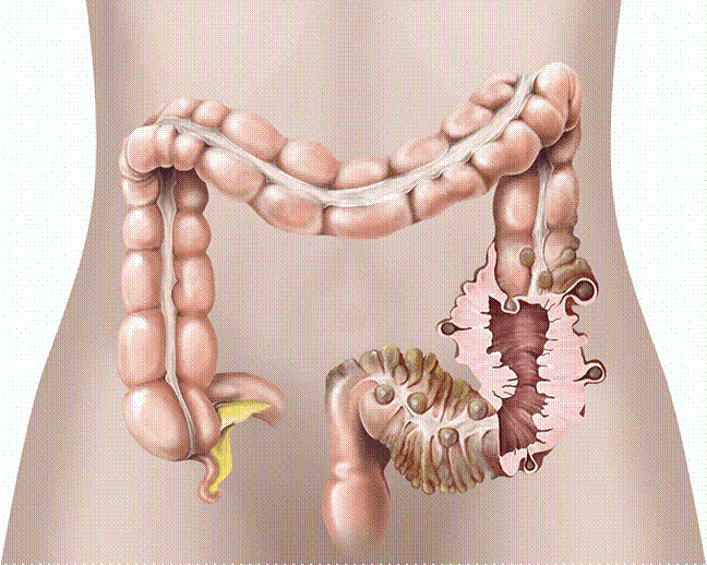 https://media.healthdirect.org.au/images/inline/original/cr07_surgery_for_diverticular_disease-30a199.png