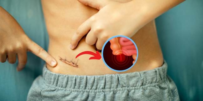 Appendix-surgery.jpg