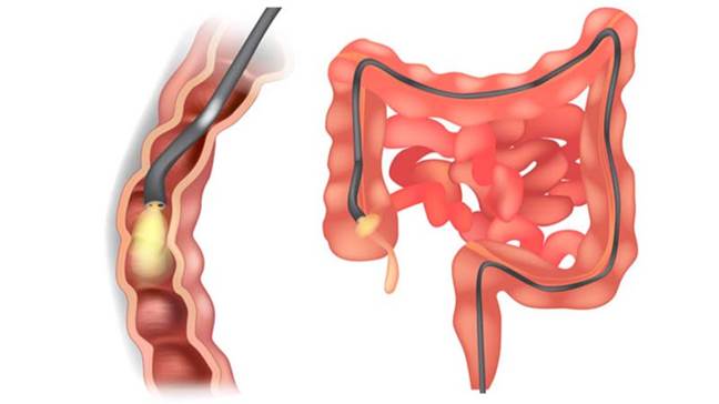 https://stgaccinwbsdevlrs01.blob.core.windows.net/newcorporatewbsite/blogs/october2023/detail-main-Procedures-and-Treatments-in-Gastroenterology-What-to-Expect-and-How-to-Prepare.jpg