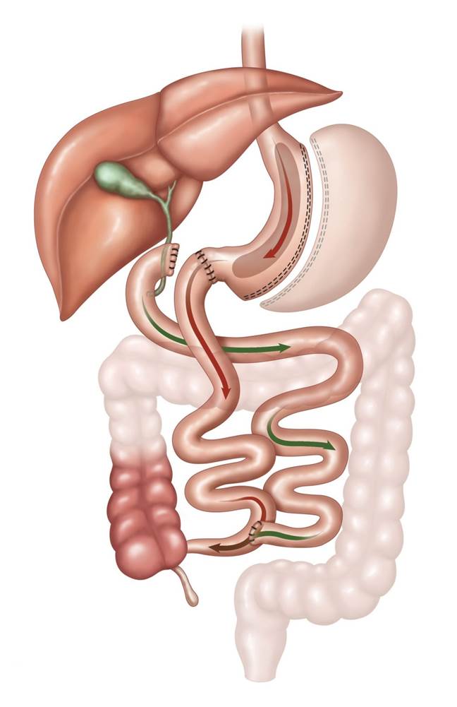 04-Duodenal_Switch-1-scaled.jpg