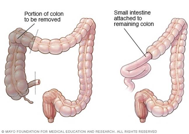 https://www.mayoclinic.org/-/media/kcms/gbs/patient-consumer/images/2013/08/26/10/38/my00141_im00231_c7_right_hemicolectomythu_jpg.jpg