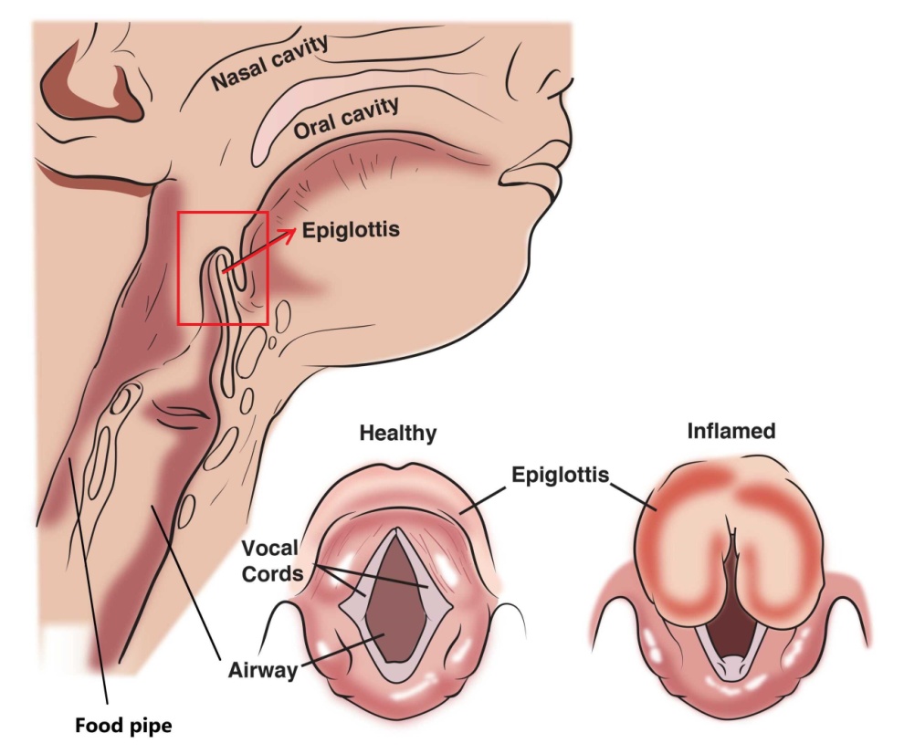 Epiglottitis_Labelled-scaled2.jpg