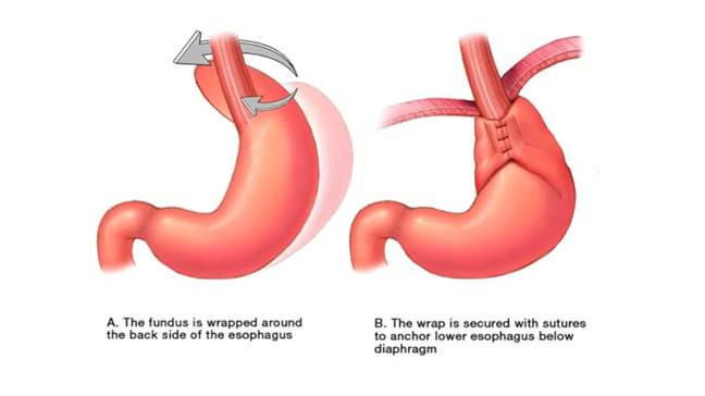 surgery-fundus-location-wrap.jpg