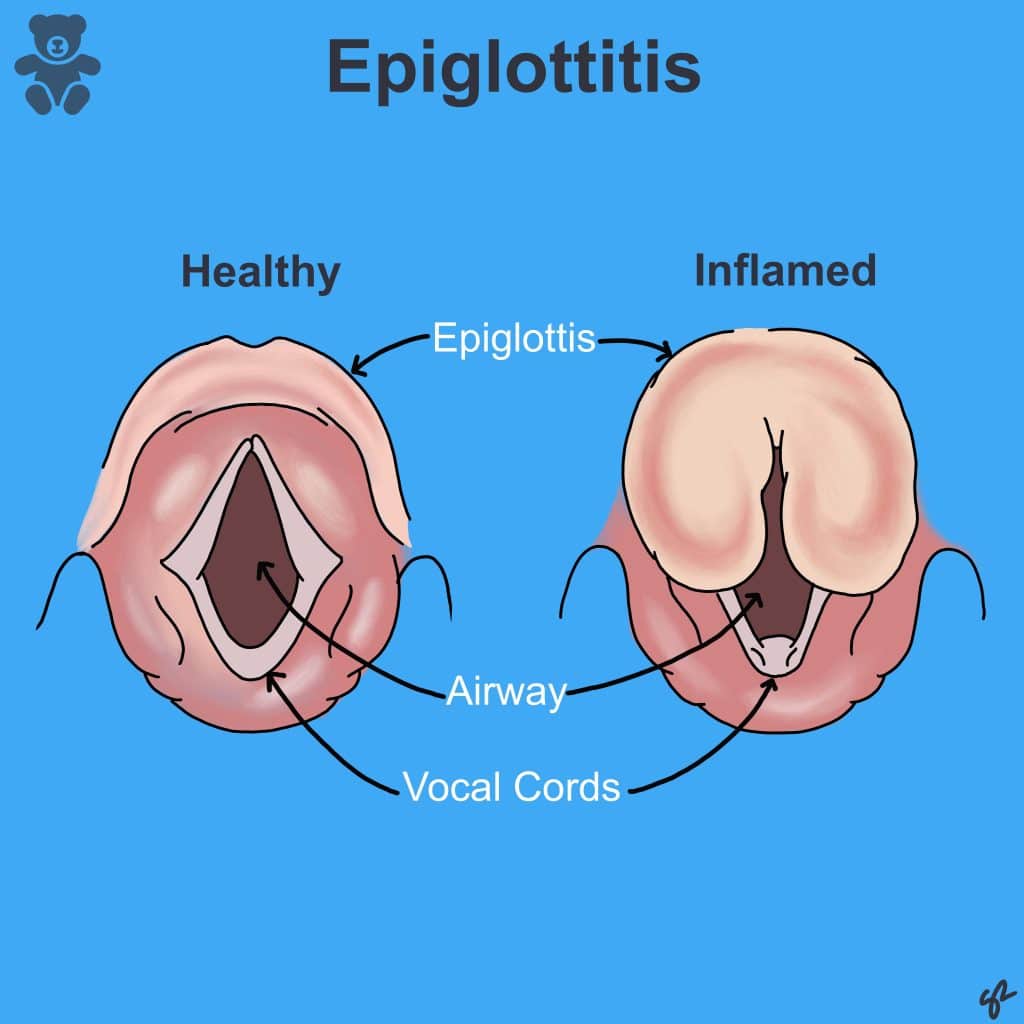 https://teachmepaediatrics.com/wp-content/uploads/2023/07/Epiglottitis-1024x1024.jpg