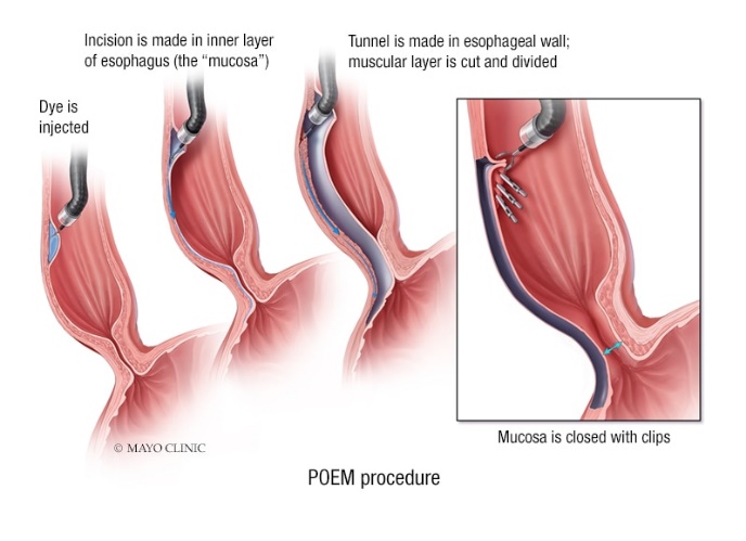 Peroral endoscopic myotomy (POEM) procedure
