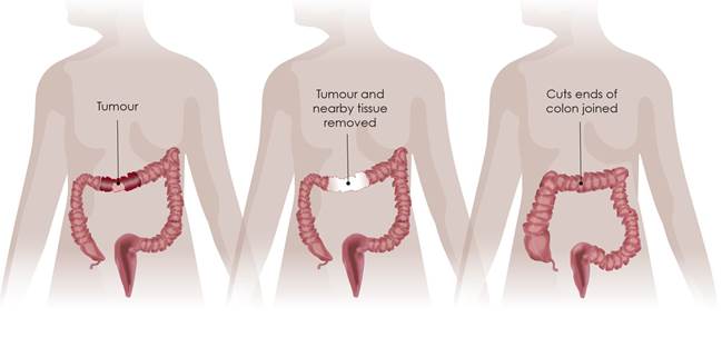 https://sp-ao.shortpixel.ai/client/to_webp,q_glossy,ret_img,w_1772,h_827/https:/digestivecancers.eu/wp-content/uploads/2021/05/8.Resection-of-the-Colon-with-Anastomosis_withlegend.jpg
