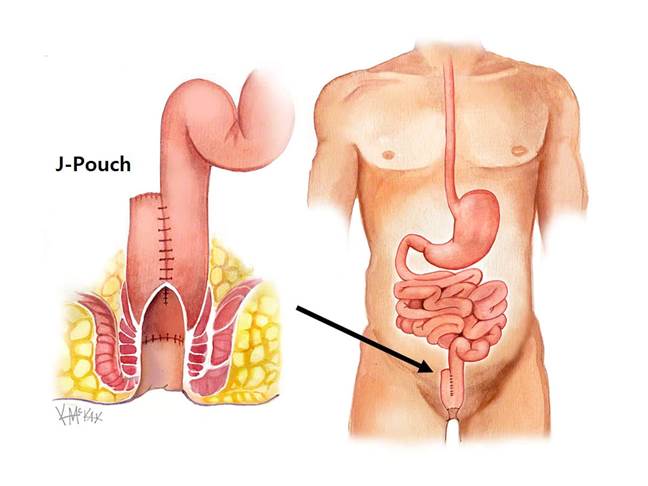 j-pouch-surgery_e.jpg