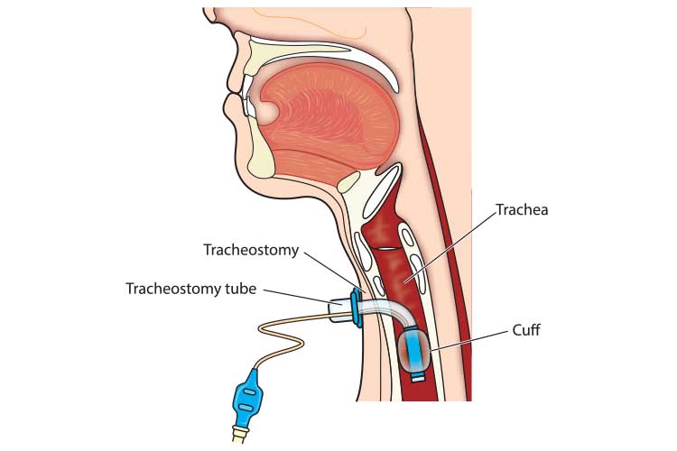 https://clinical.stjohnwa.com.au/images/default-source/medical-library-images/trache.jpg?sfvrsn=aac896c2_0