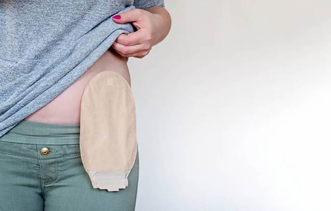 https://www.niddk.nih.gov/-/media/Images/Health-Information/Digestive-Diseases/front-view-colostomy-pouch-skin_660x420.jpg