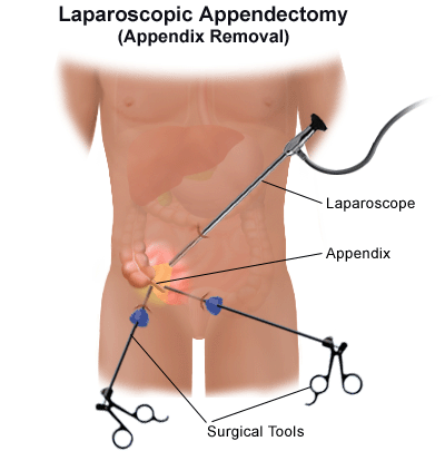 laparoscopic-appendectomy.png