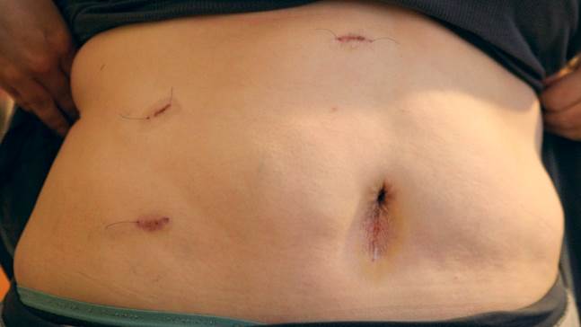 https://post.healthline.com/wp-content/uploads/2023/03/laparoscopic-gallbladder-removal-surgery-cholecystectomy-body.jpg