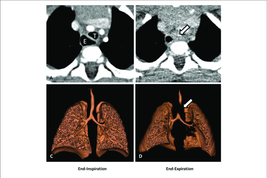 https://www.researchgate.net/publication/337910334/figure/fig3/AS:835301740126209@1576162862360/Dynamic-airway-CT-scan-with-3-D-reconstruction-A-CT-scan-cross-sectional-view.png