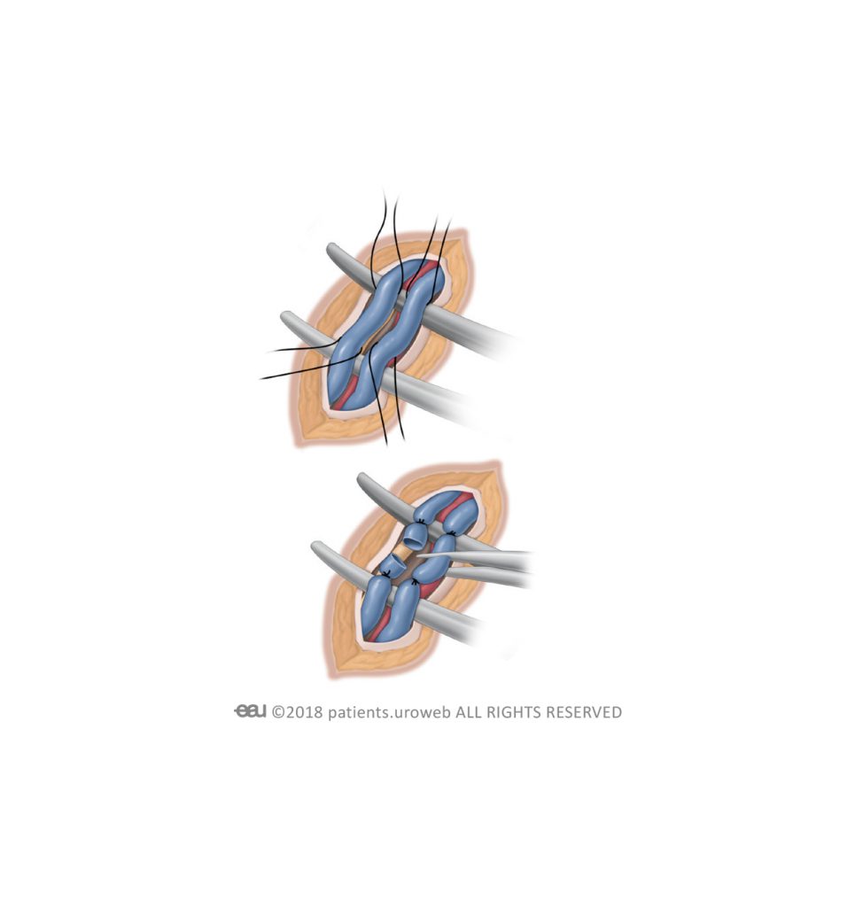 سوالات متداول در مورد واریکوسل (Varicocele)