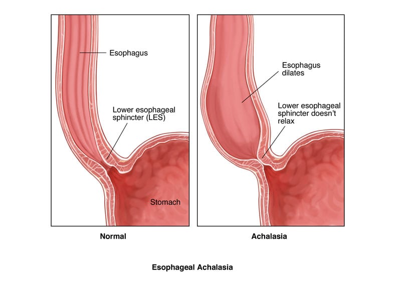 آشالازی (Achalasia)