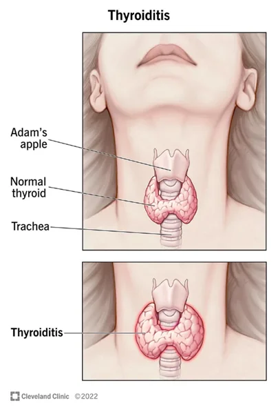 سوالات متداول در مورد بیماری تیروئیدیت (Thyroiditis)