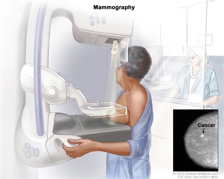 شکل و ظاهر سرطان سینه در ماموگرافی