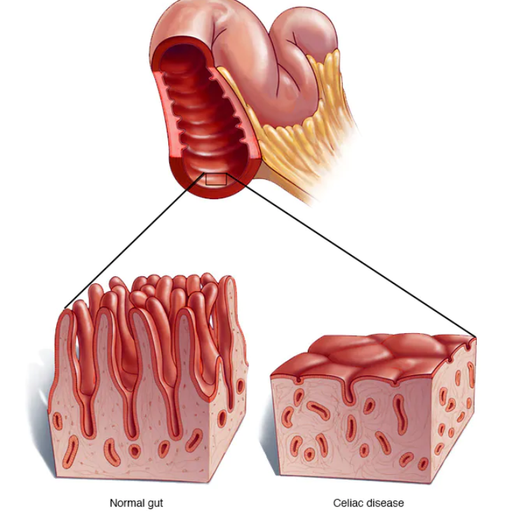 سوالات متداول در مورد بیماری سلیاک (Celiac Disease)