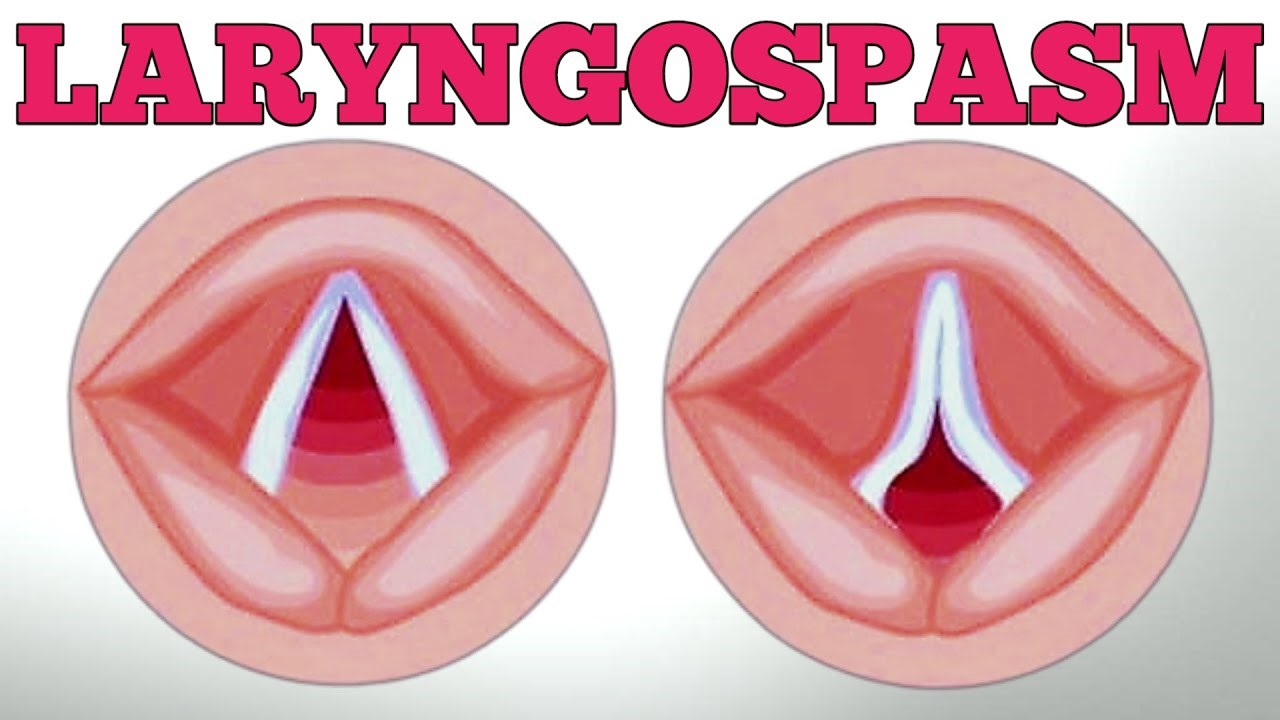 لارنگواسپاسم یا اسپاسم حنجره