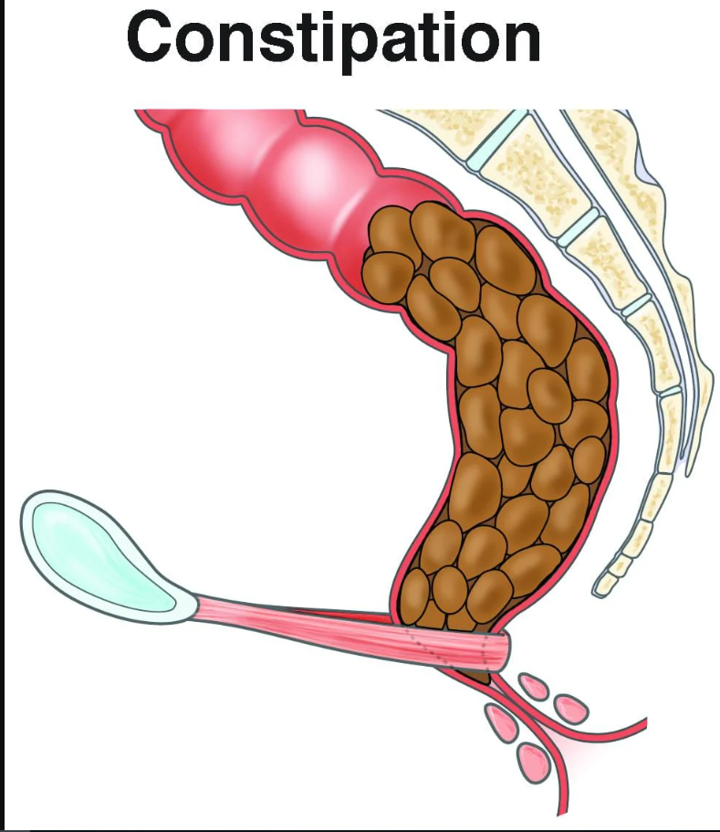 سوالات متداول در مورد یبوست (Constipation)