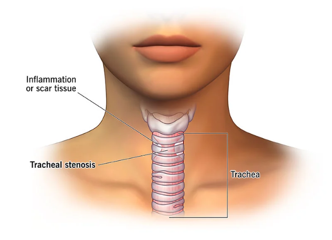 تنگی تراشه (Tracheal Stenosis)