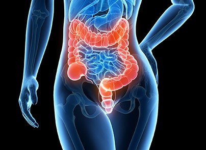 چه عواملی باعث سرطان روده میشوند؟