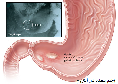 بیماری زخم گوارشی یا زخم پپتیک (Peptic Ulcer Disease)