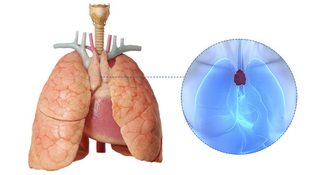 همه چیز درباره سرطان ریه