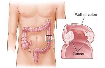 سوالات متداول در مورد سرطان روده بزرگ