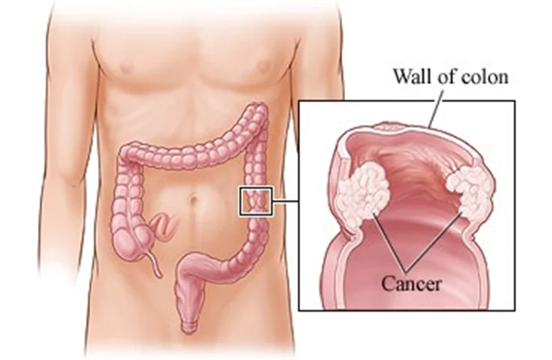 سوالات متداول در مورد سرطان روده بزرگ
