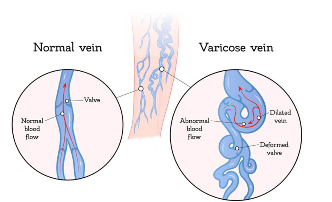 سوالات متداول در مورد واریس در دستگاه تناسلی زنانه (واریکوسیته فرج)