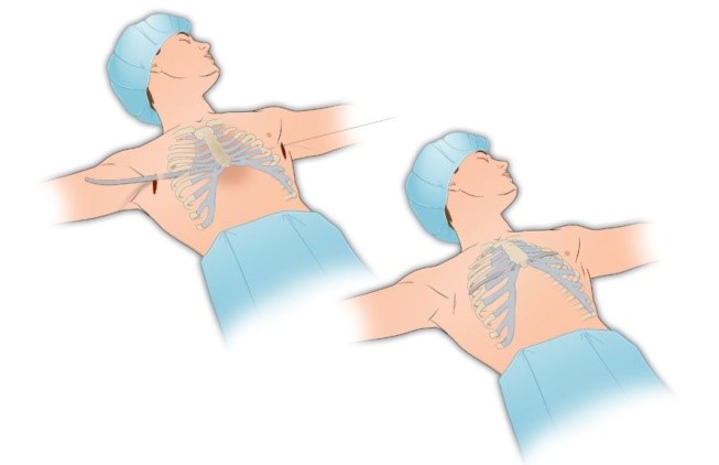 عمل جراحی تغییرات مادرزادی قفسه صدری