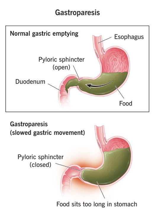 گاستروپارزی (Gastroparesis)