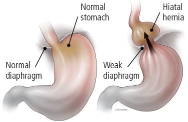 فتق هیاتال (Hiatal Hernia)