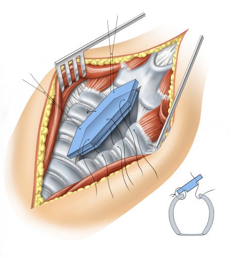 عمل جراحی بازسازی نای حنجره