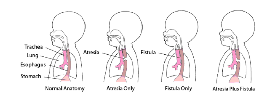 فیستول تراکئوازوفاژیال (Tracheoesophageal Fistula)
