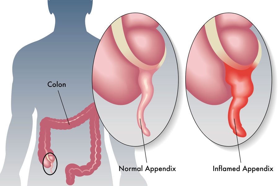 سوالات متداول در مورد آپاندیسیت (Appendicitis)