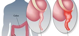 سوالات متداول در مورد آپاندیسیت (Appendicitis)