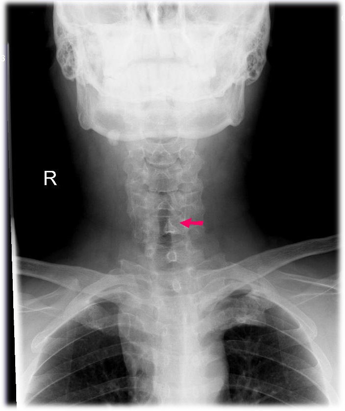 تنگی نای در زیر تارهای صوتی